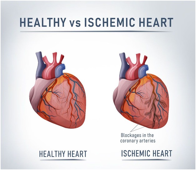 coronary-artery-disease-ischemic-heart-disease-overview-coronary